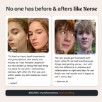 Norse Organics - Kill Acne & Redness Ritual